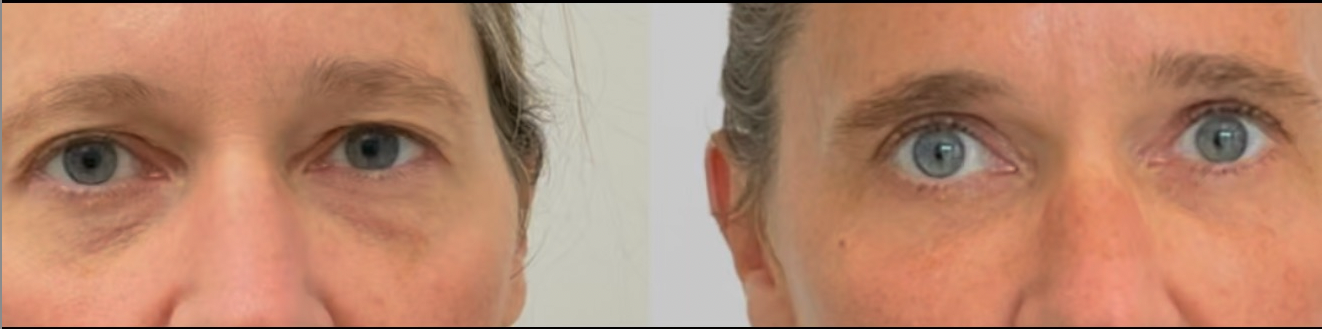 Eyelid surgery before and after