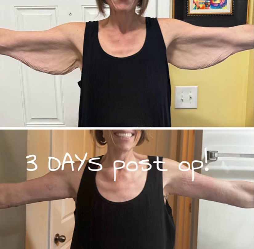Arm lift result at 3 days post-op