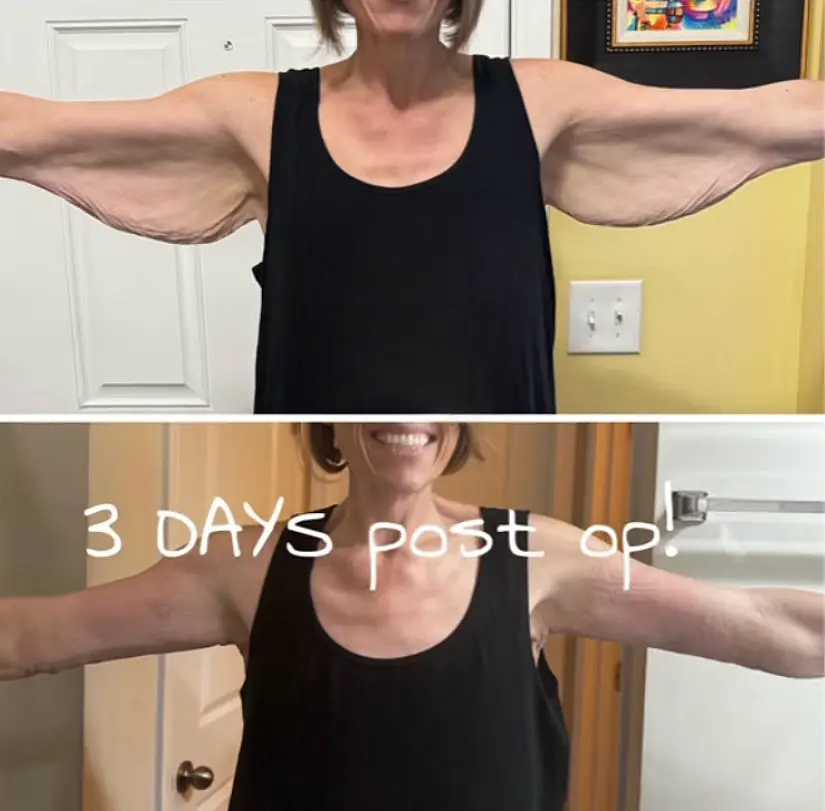 Arm lift result at three days post-op