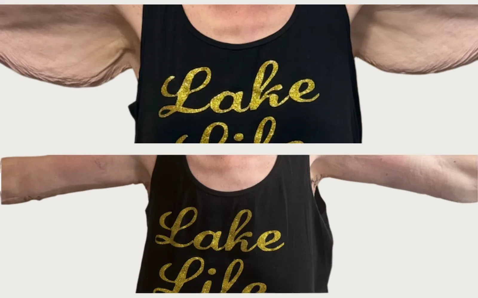 Arm Lift before and after, patient 1, Holy City Plastic Surgery, Charleston SC