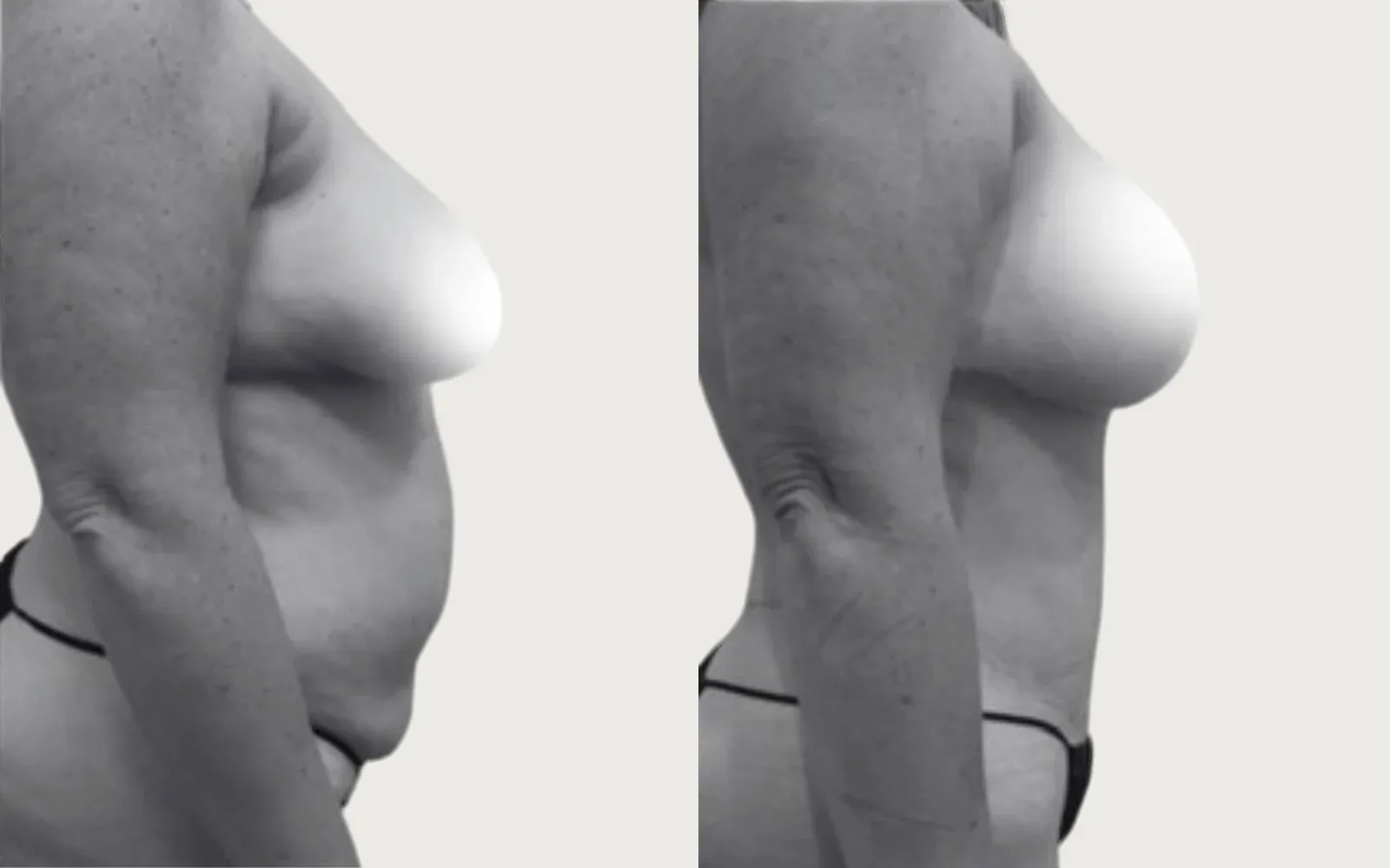 Mommy Makeover before and after, patient 1, Holy City Plastic Surgery, Charleston SC