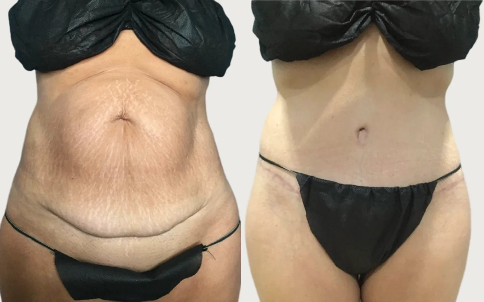 Tummy Tuck before and after, patient 1, Holy City Plastic Surgery, Charleston SC