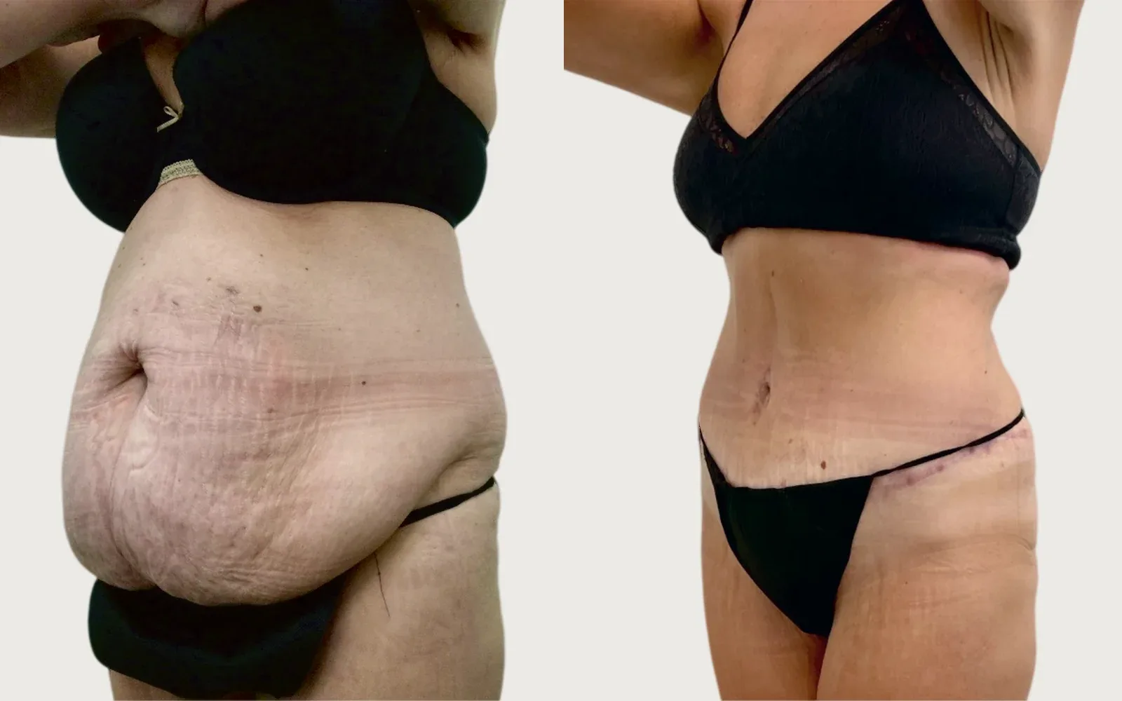 Tummy Tuck before and after, patient 2, Holy City Plastic Surgery, Charleston SC