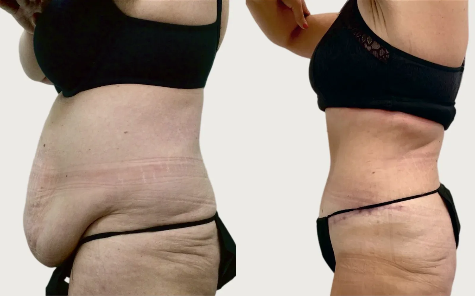 Tummy Tuck before and after, patient 2, Holy City Plastic Surgery, Charleston SC