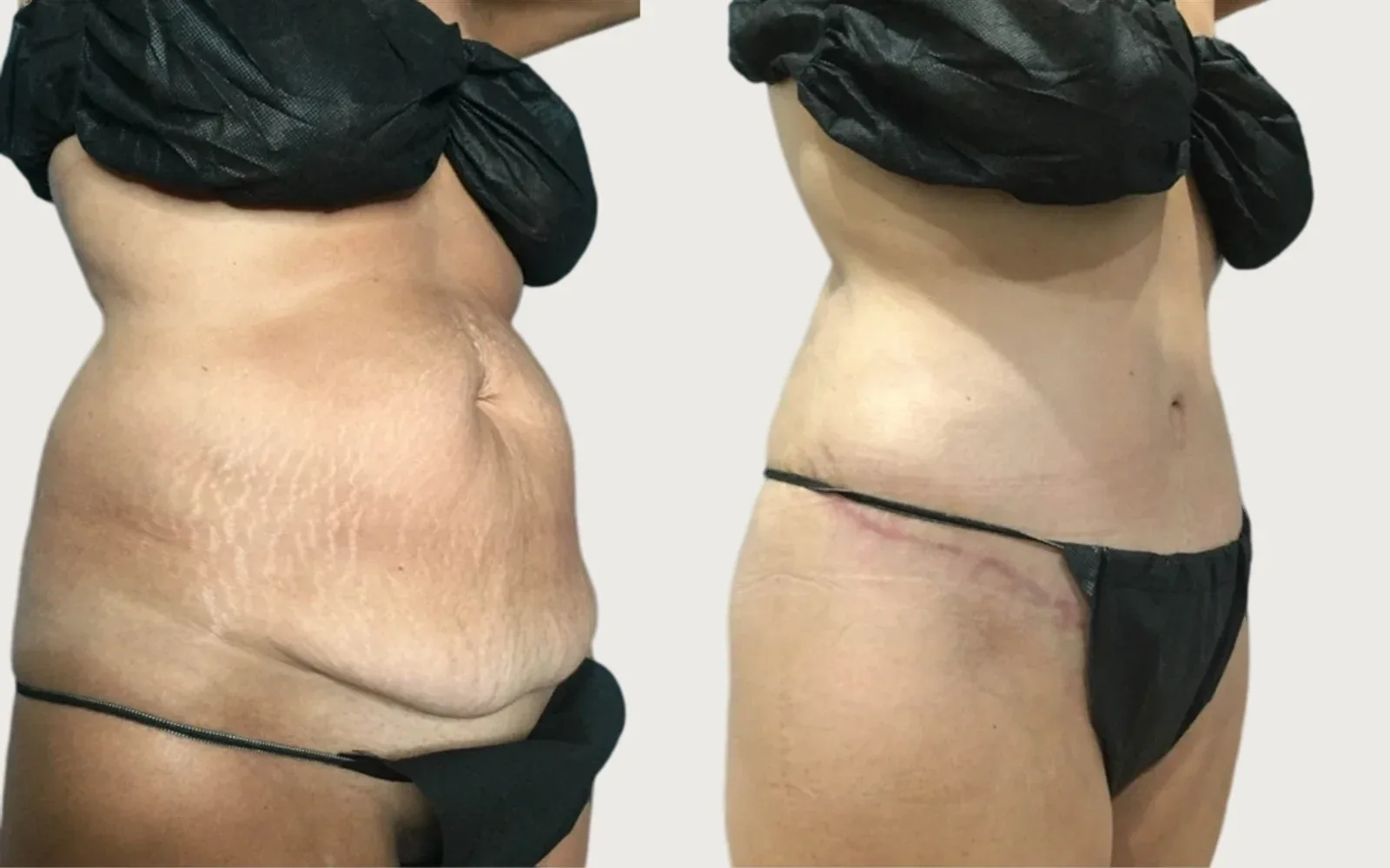 Tummy Tuck before and after, patient 3, Holy City Plastic Surgery, Charleston SC