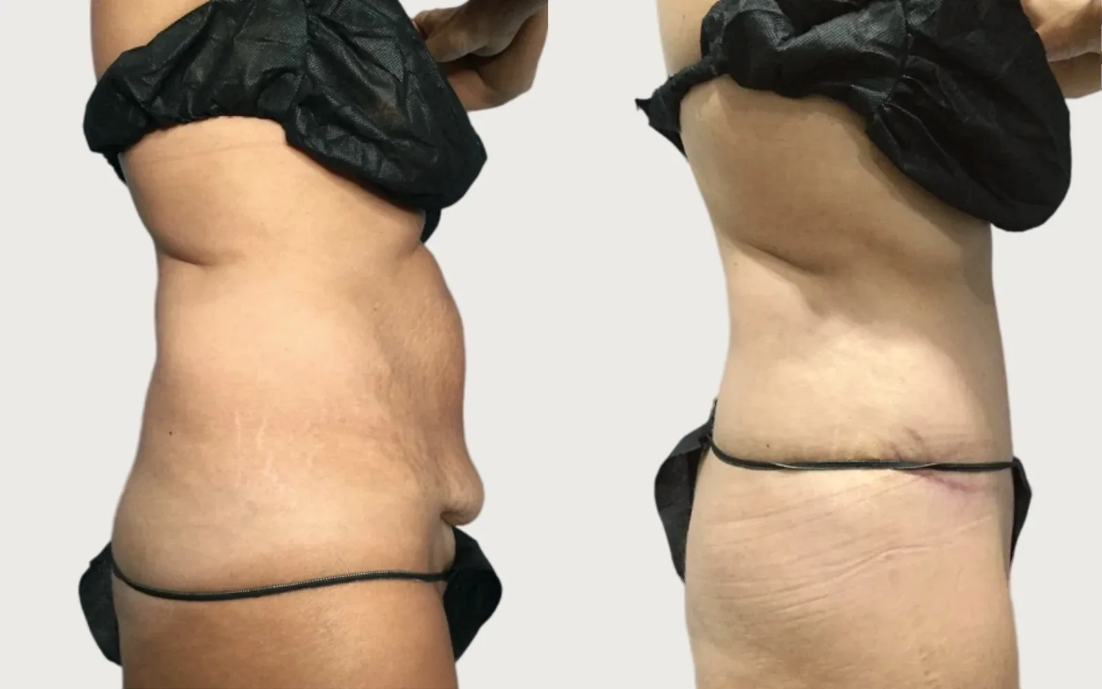 Tummy Tuck before and after, patient 3, Holy City Plastic Surgery, Charleston SC