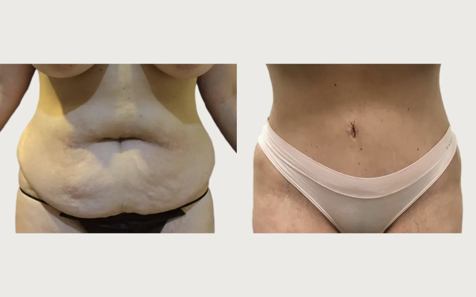 Tummy Tuck before and after, patient 4, Holy City Plastic Surgery, Charleston SC