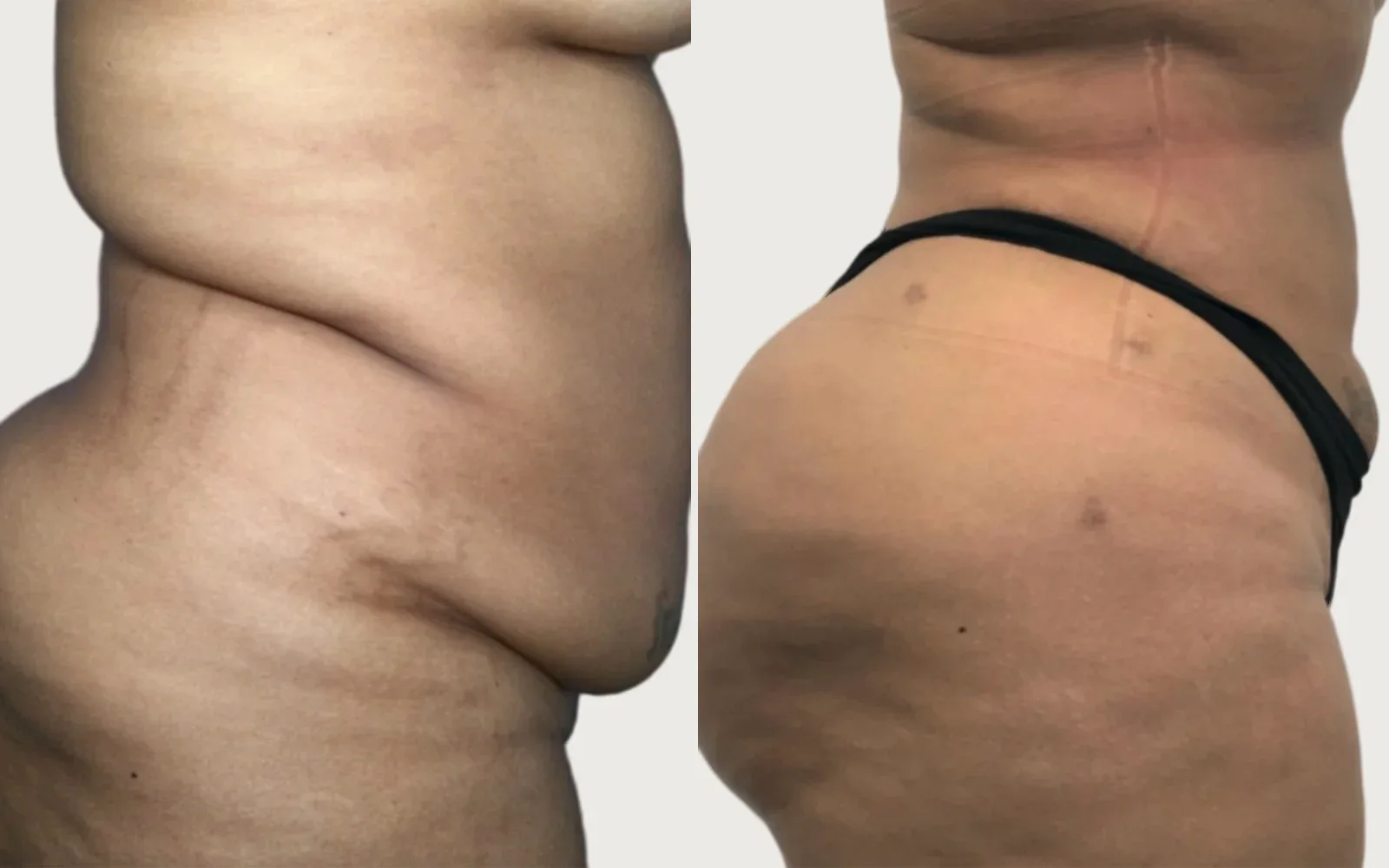 Tummy Tuck before and after, patient 5, Holy City Plastic Surgery, Charleston SC