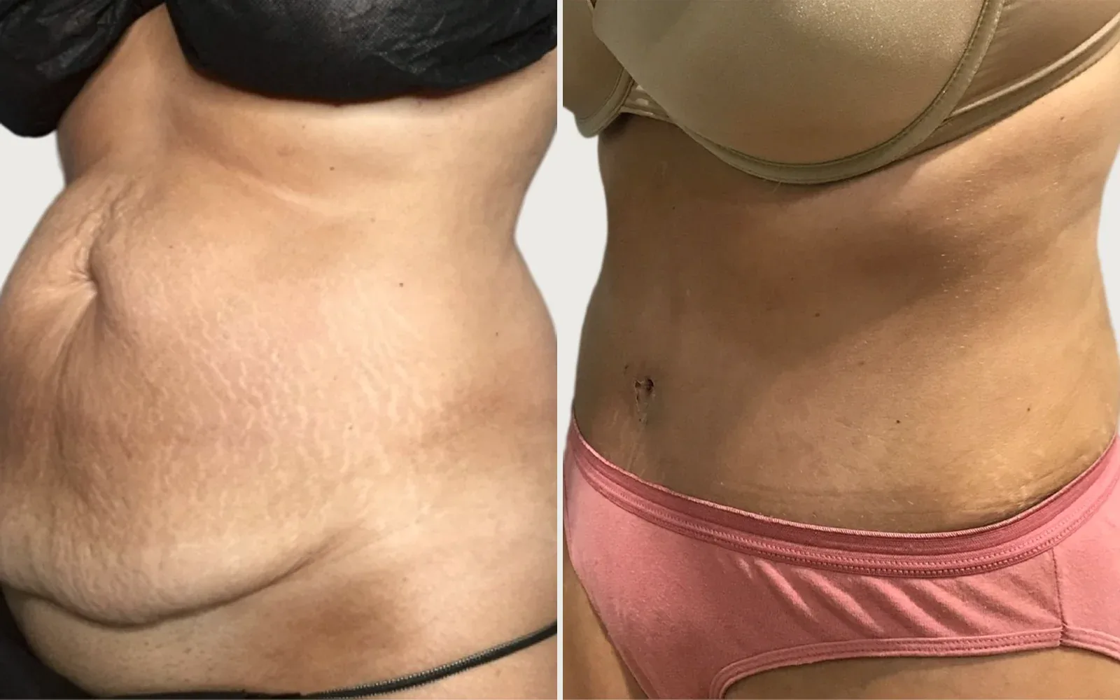 Tummy Tuck before and after, patient 6, Holy City Plastic Surgery, Charleston SC