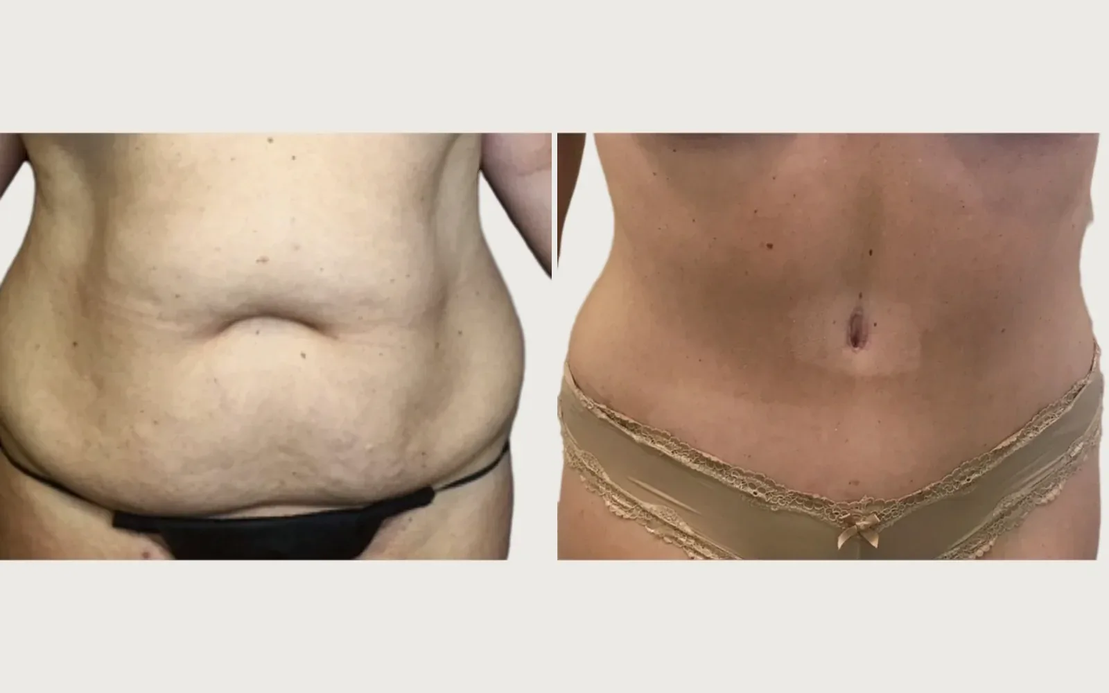 Tummy Tuck before and after, patient 7, Holy City Plastic Surgery, Charleston SC