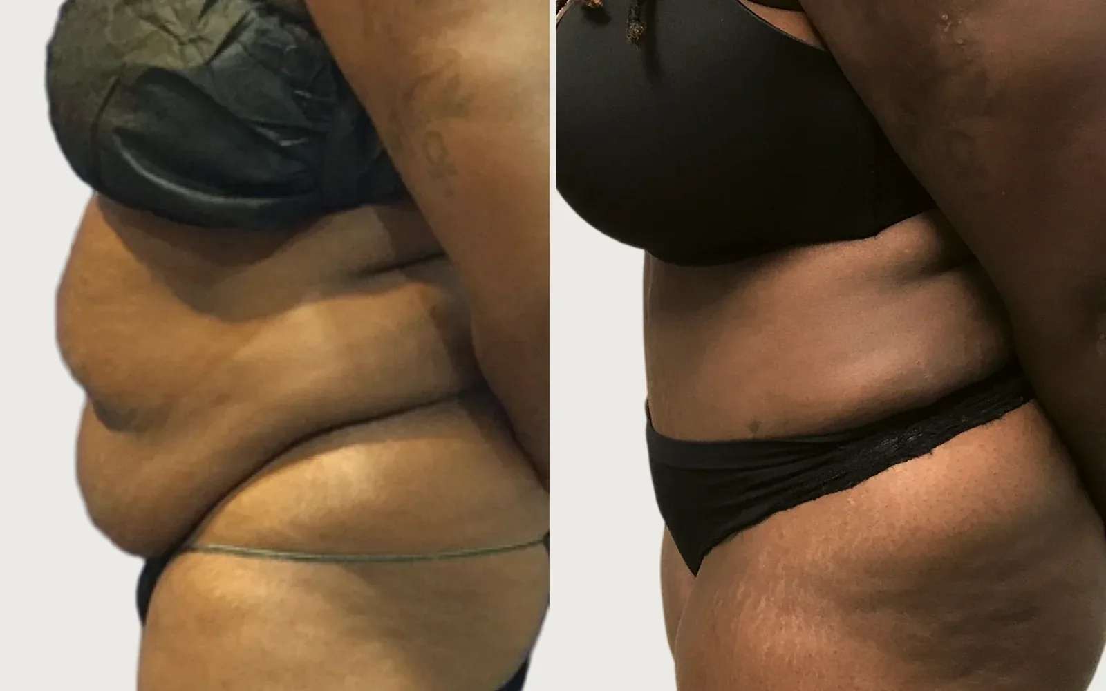 Tummy Tuck before and after, patient 8, Holy City Plastic Surgery, Charleston SC