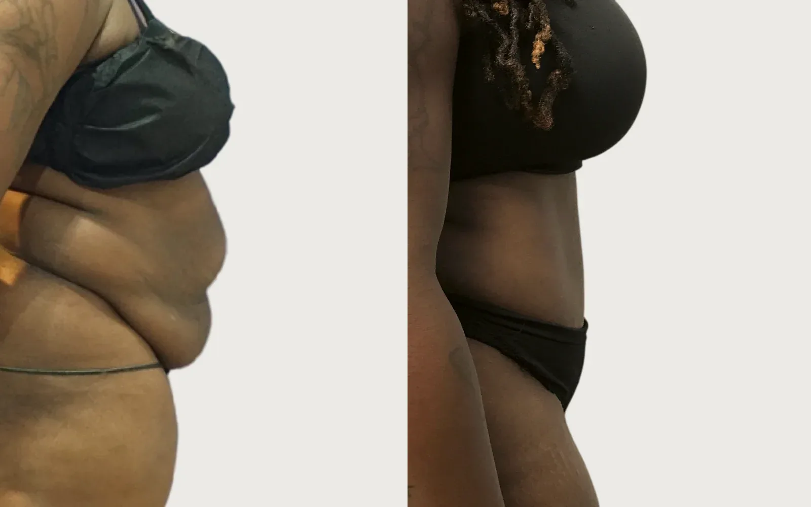 Tummy Tuck before and after, patient 8, Holy City Plastic Surgery, Charleston SC