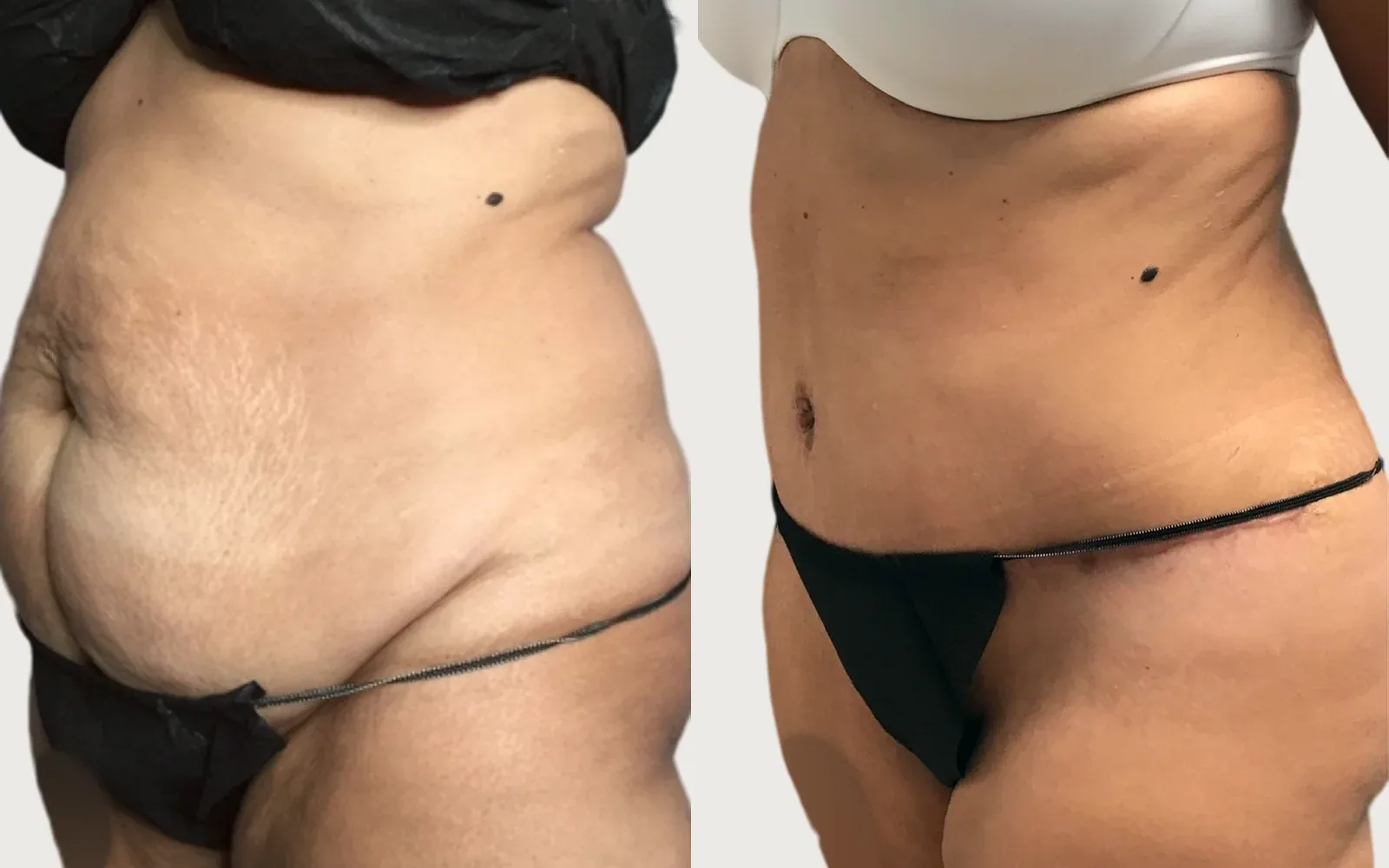 Tummy Tuck before and after, patient 9, Holy City Plastic Surgery, Charleston SC