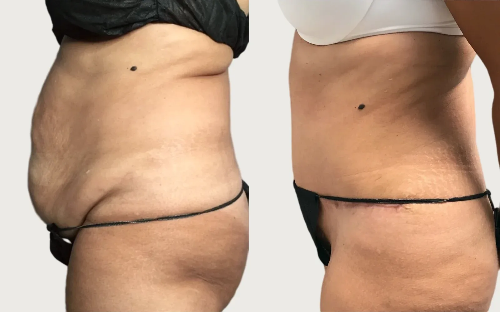 Tummy Tuck before and after, patient 9, Holy City Plastic Surgery, Charleston SC