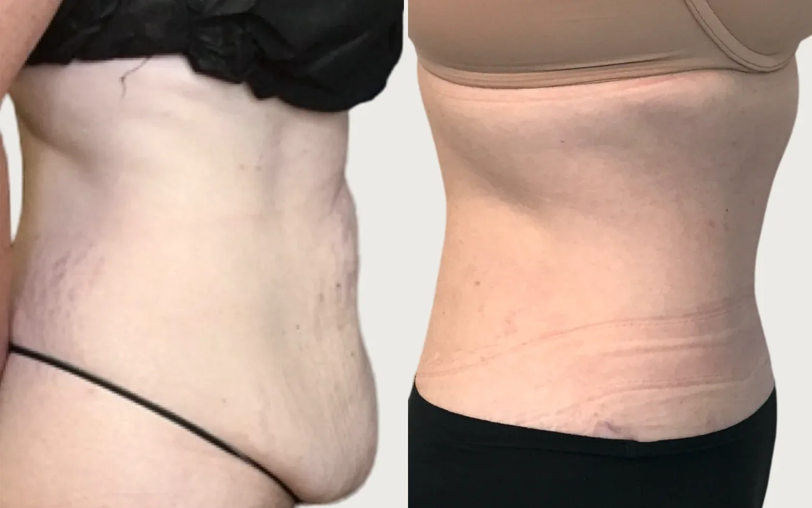 Tummy Tuck before and after, patient 10, Holy City Plastic Surgery, Charleston SC