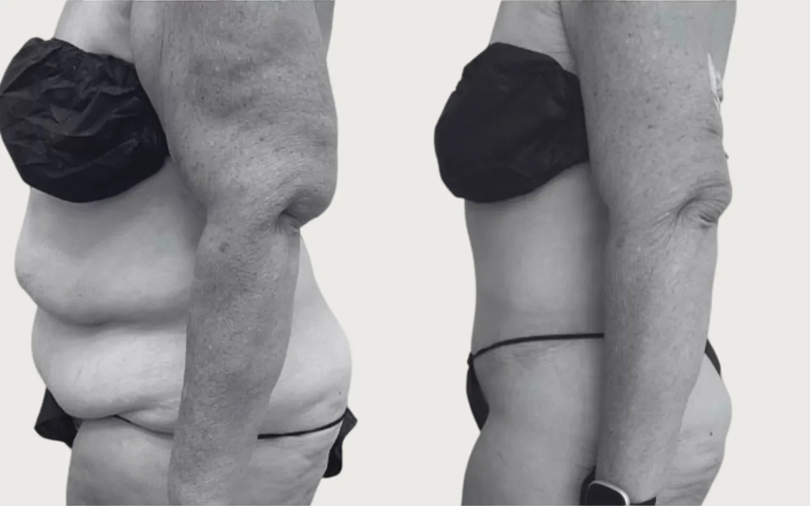 Tummy Tuck before and after, patient 11, Holy City Plastic Surgery, Charleston SC