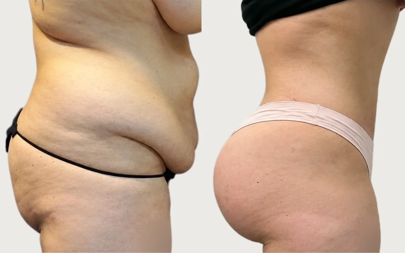 Tummy Tuck before and after, patient 4, Holy City Plastic Surgery, Charleston SC