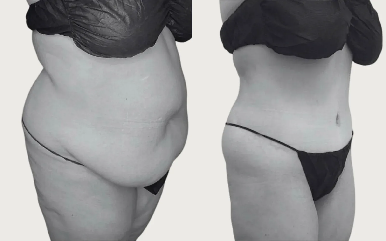 Tummy Tuck before and after, patient 12, Holy City Plastic Surgery, Charleston SC