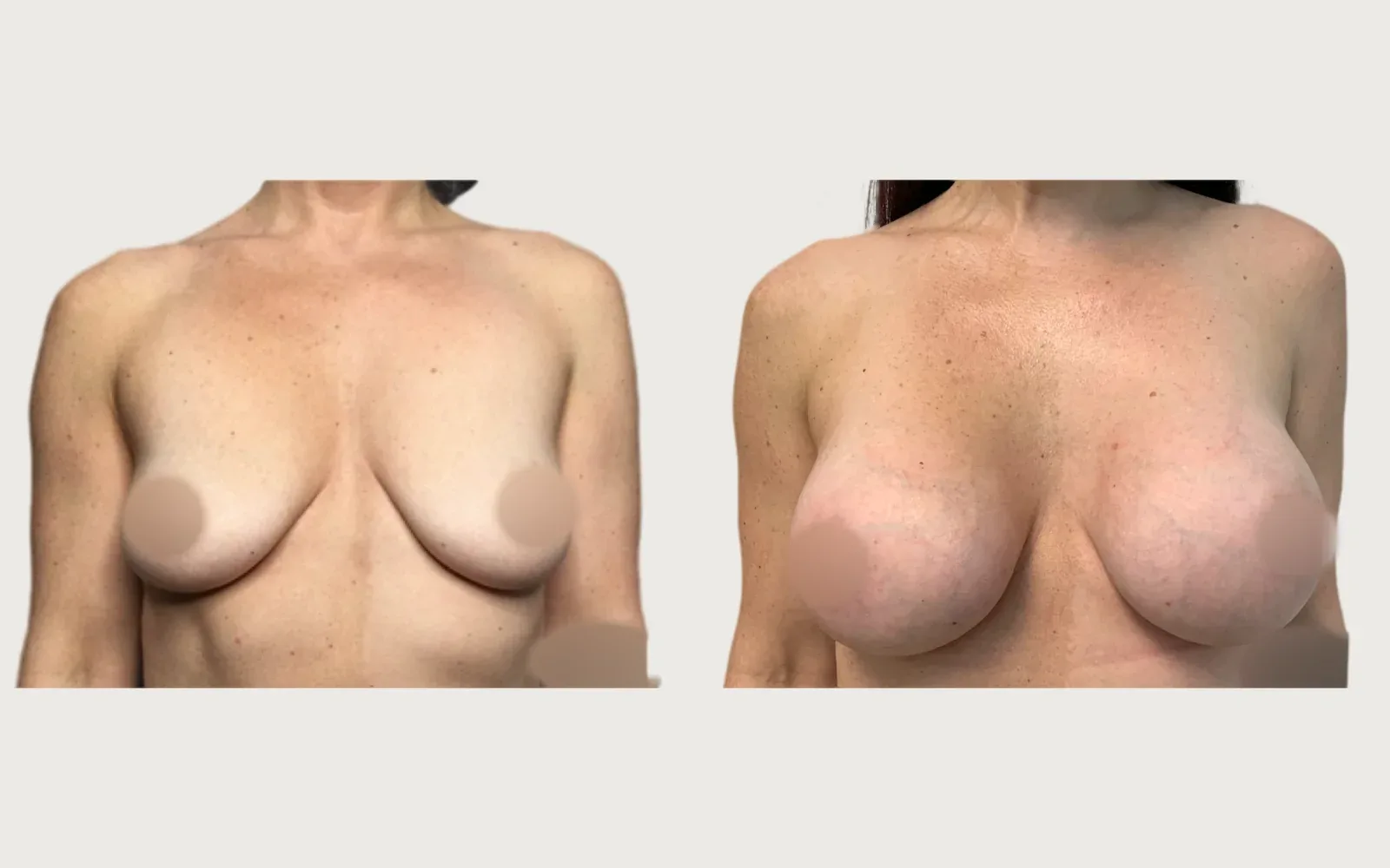 Breast Augmentation before and after, patient 1, Holy City Plastic Surgery, Charleston SC