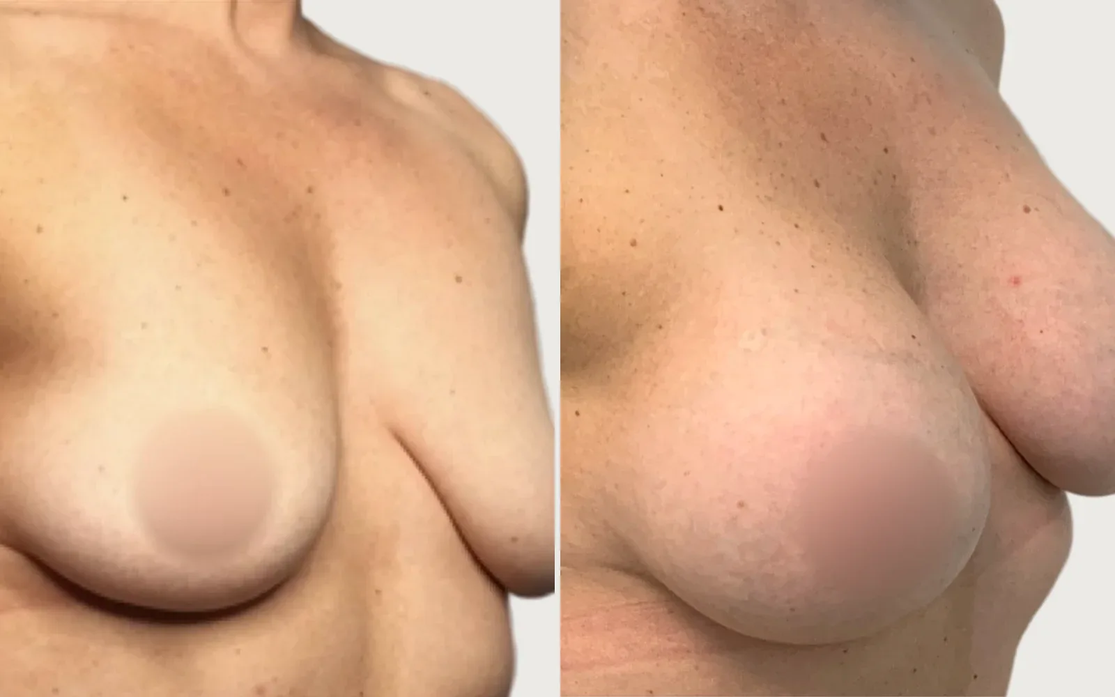Breast Augmentation before and after, patient 1, Holy City Plastic Surgery, Charleston SC