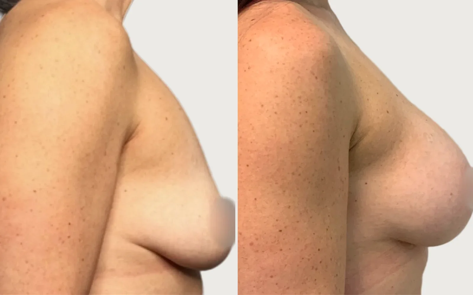 Breast Augmentation before and after, patient 1, Holy City Plastic Surgery, Charleston SC