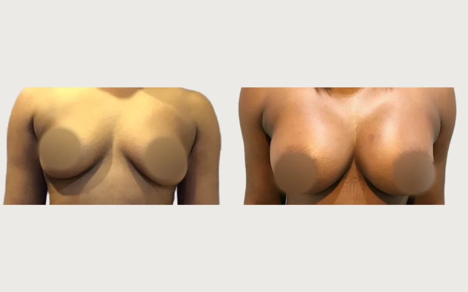 Breast Augmentation before and after, patient 3, Holy City Plastic Surgery, Charleston SC