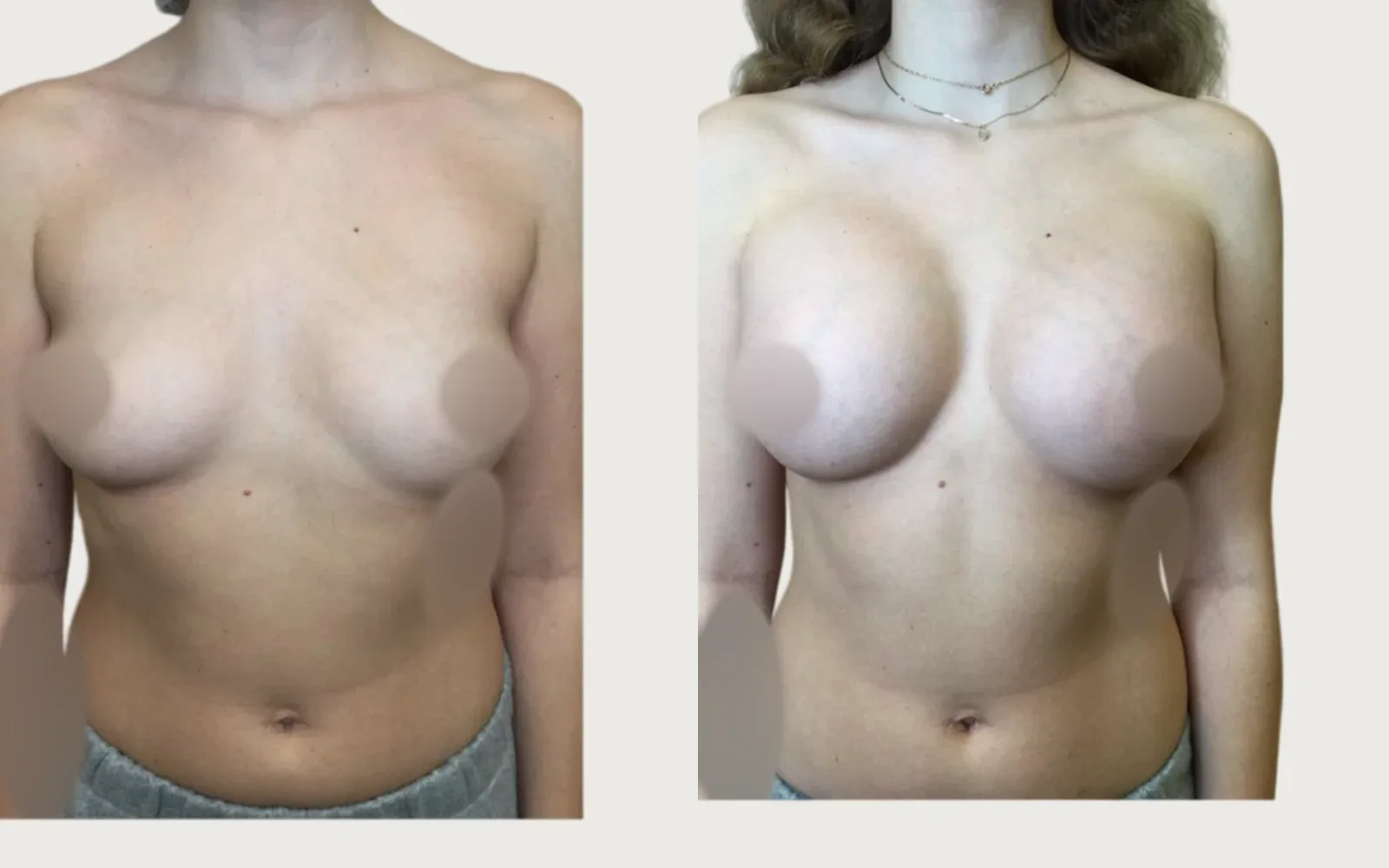 Breast Augmentation before and after, patient 5, Holy City Plastic Surgery, Charleston SC