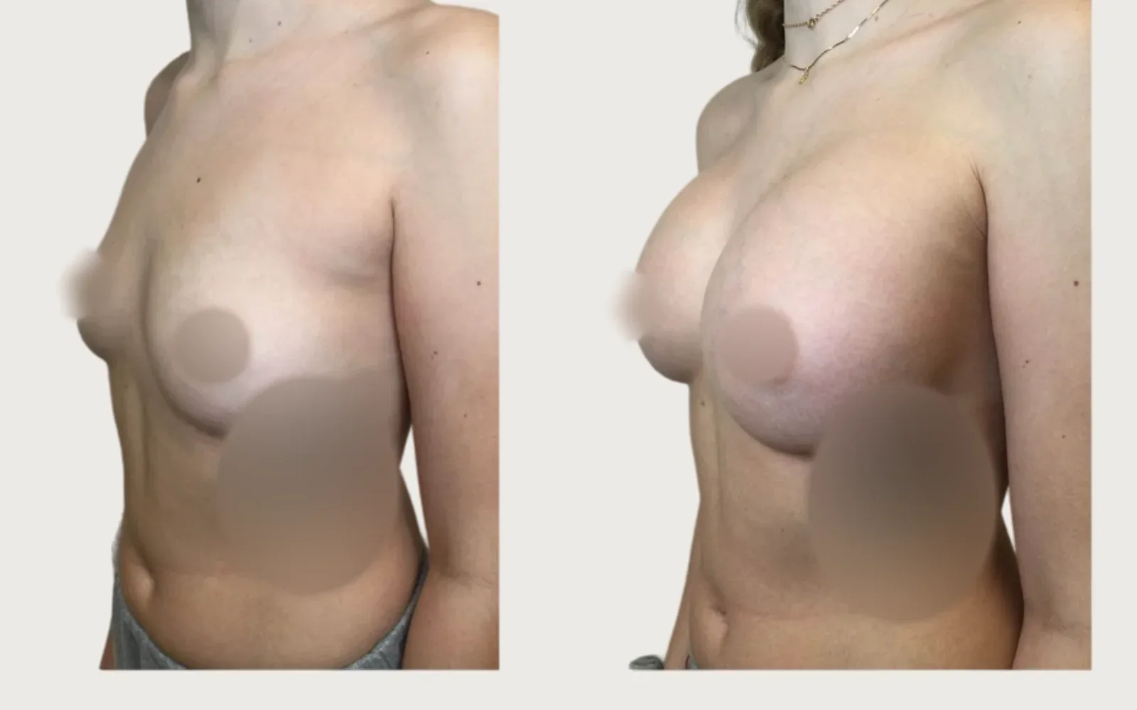 Breast Augmentation before and after, patient 5, Holy City Plastic Surgery, Charleston SC