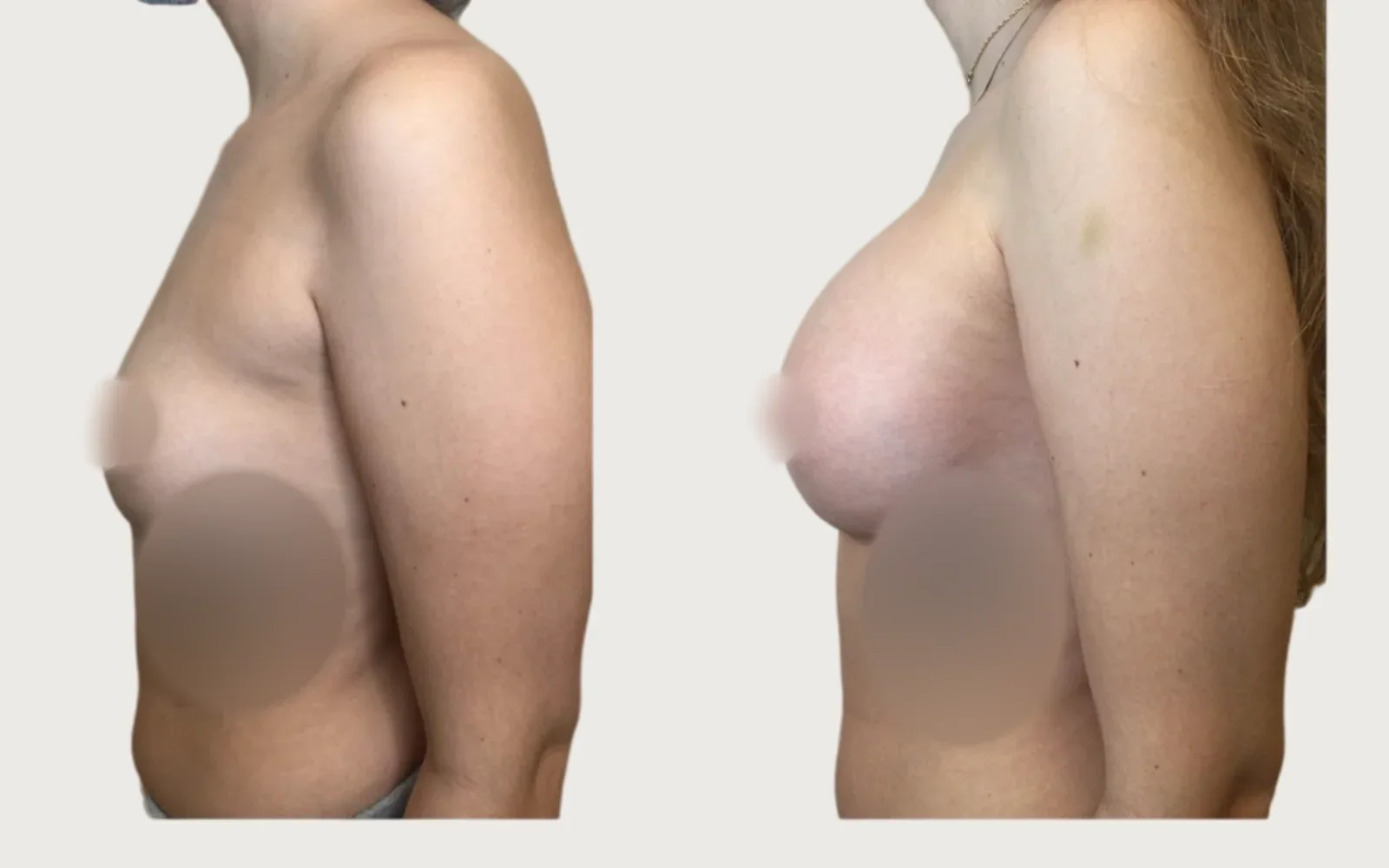 Breast Augmentation before and after, patient 5, Holy City Plastic Surgery, Charleston SC
