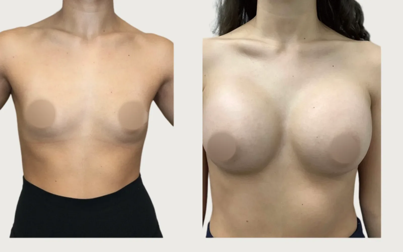 Breast Augmentation before and after, patient 6, Holy City Plastic Surgery, Charleston SC