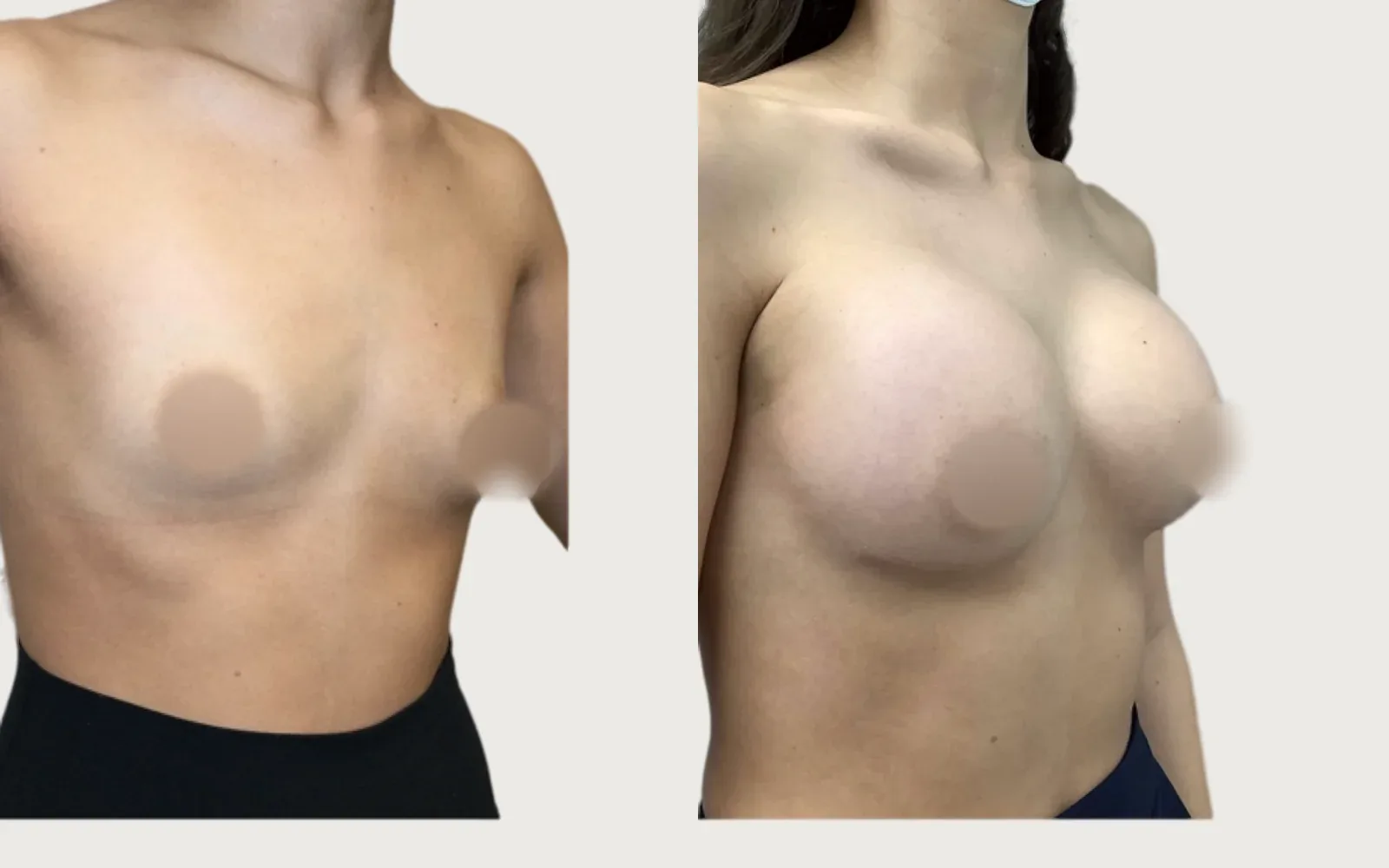 Breast Augmentation before and after, patient 6, Holy City Plastic Surgery, Charleston SC