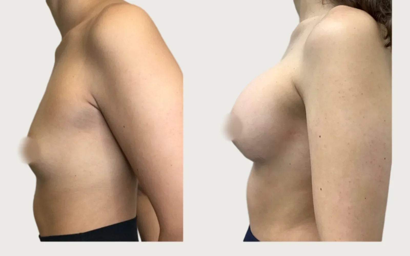 Breast Augmentation before and after, patient 6, Holy City Plastic Surgery, Charleston SC