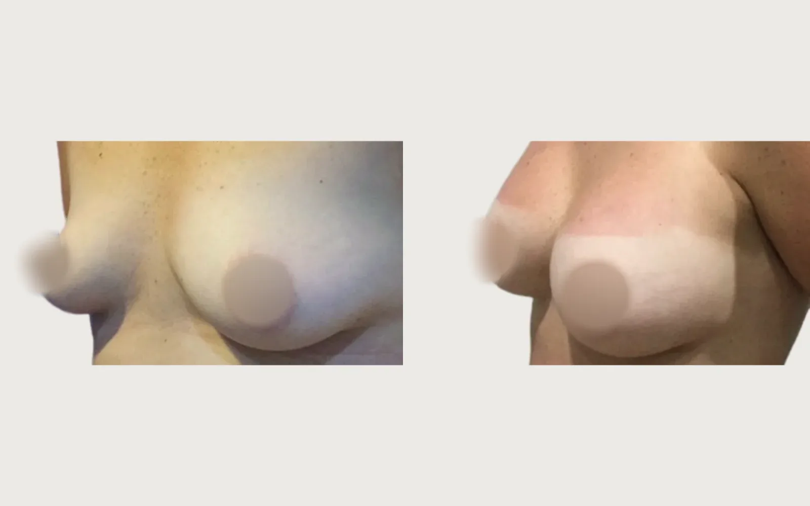 Breast Augmentation before and after, patient 7, Holy City Plastic Surgery, Charleston SC