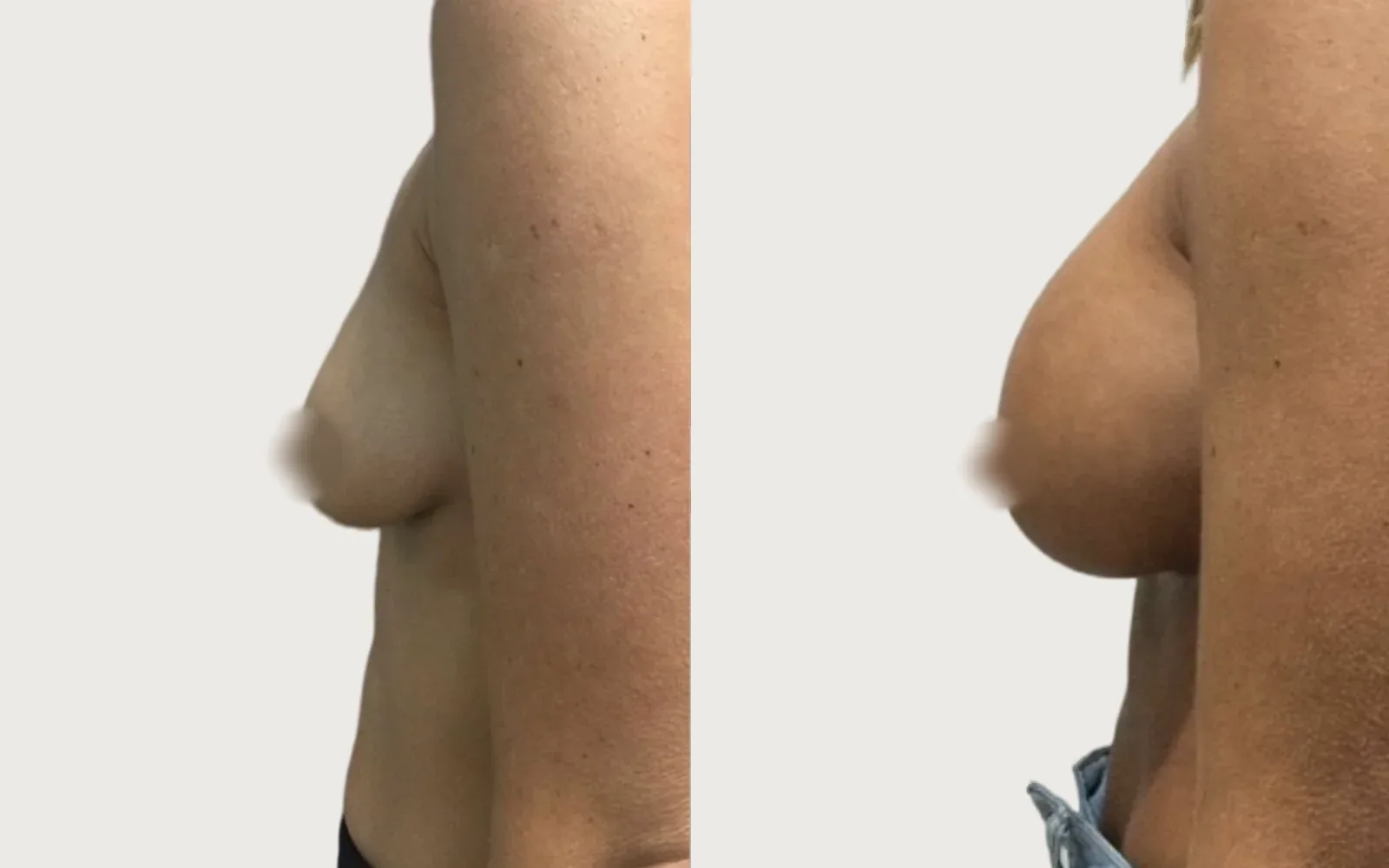 Breast Augmentation before and after, patient 8, Holy City Plastic Surgery, Charleston SC