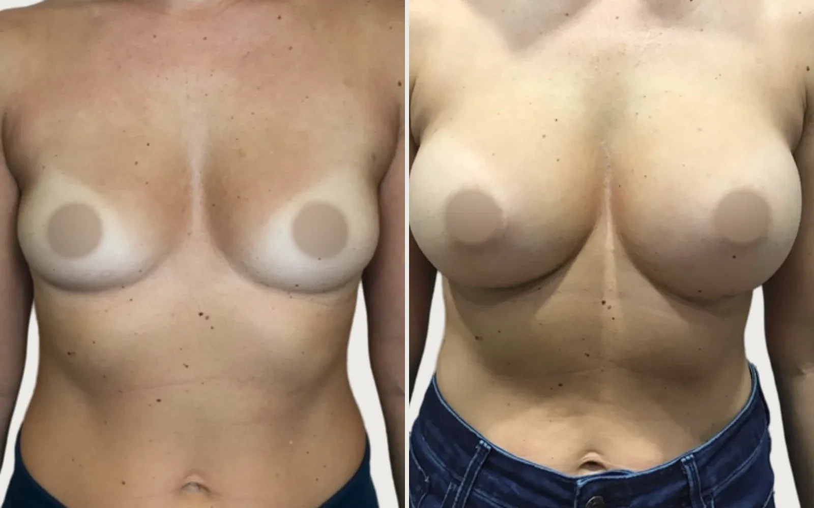 Breast Augmentation before and after, patient 10, Holy City Plastic Surgery, Charleston SC