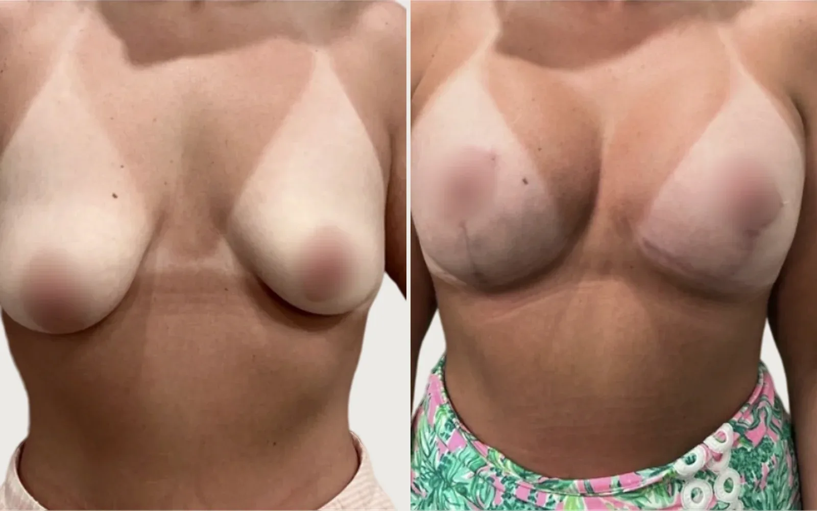 Breast Lift before and after, patient 1, Holy City Plastic Surgery, Charleston SC