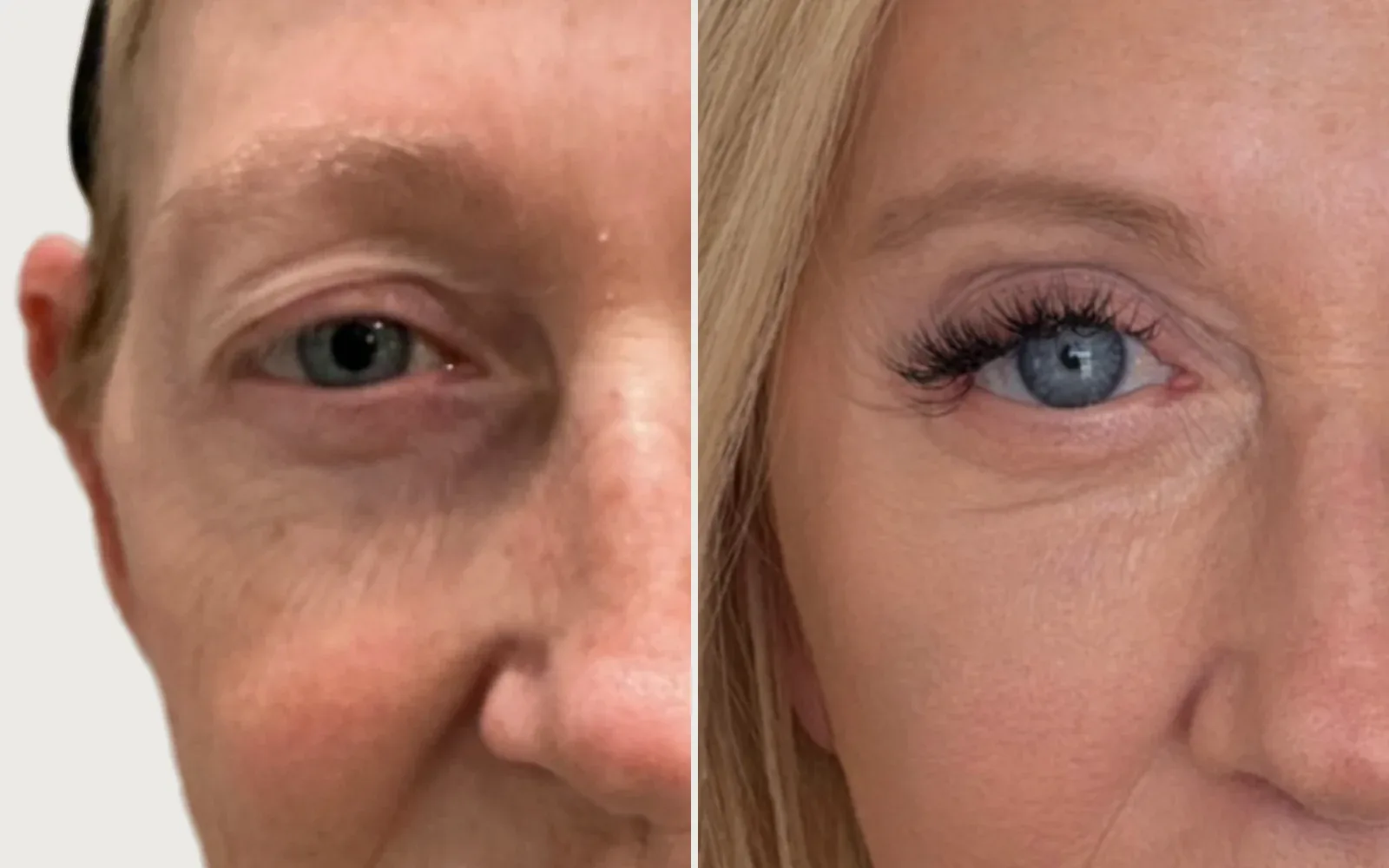 Eyelid / Brow Surgery before and after, patient 1, Holy City Plastic Surgery, Charleston SC