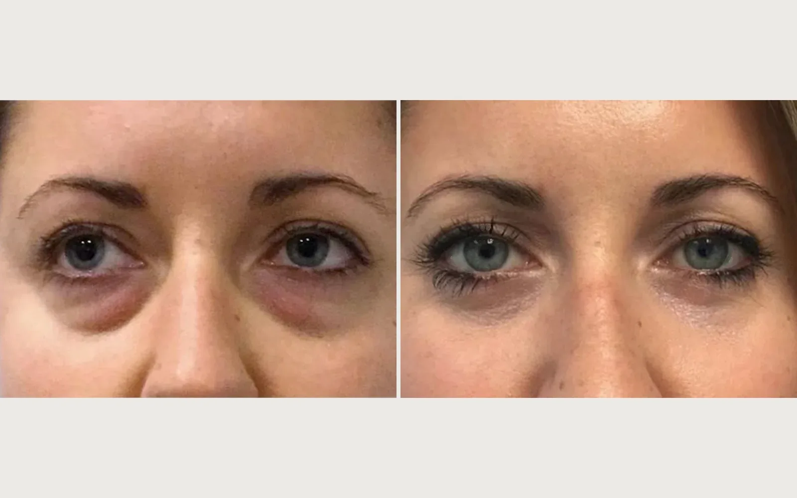 Eyelid / Brow Surgery before and after, patient 2, Holy City Plastic Surgery, Charleston SC