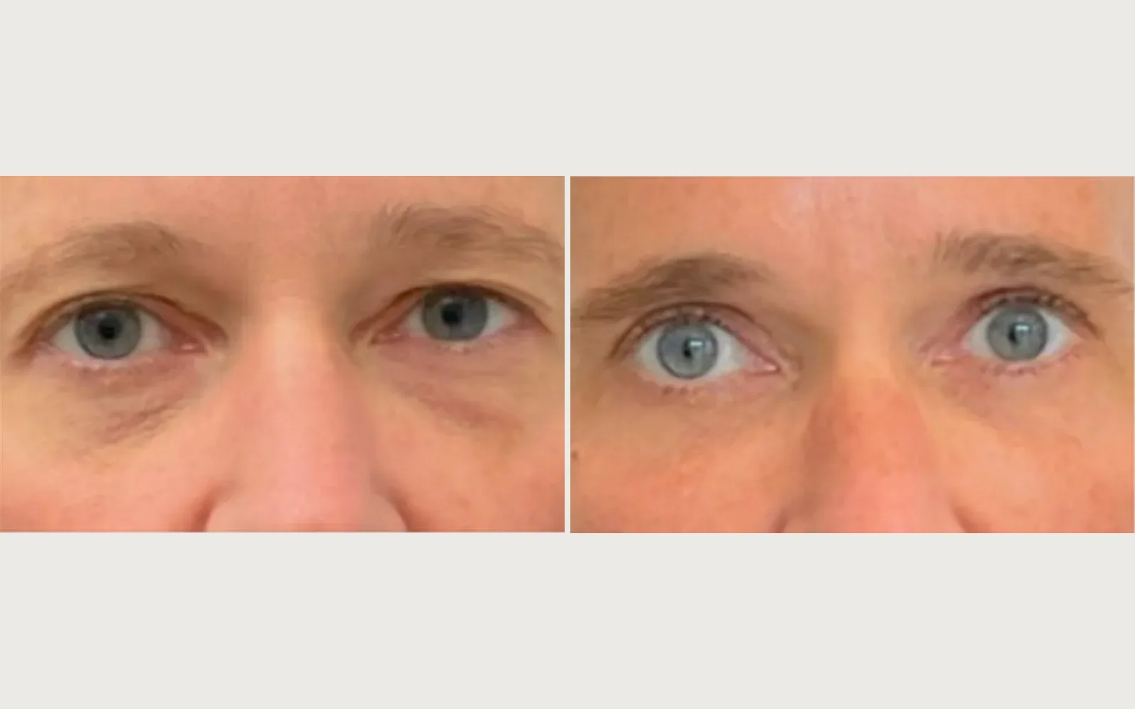 Eyelid / Brow Surgery before and after, patient 3, Holy City Plastic Surgery, Charleston SC