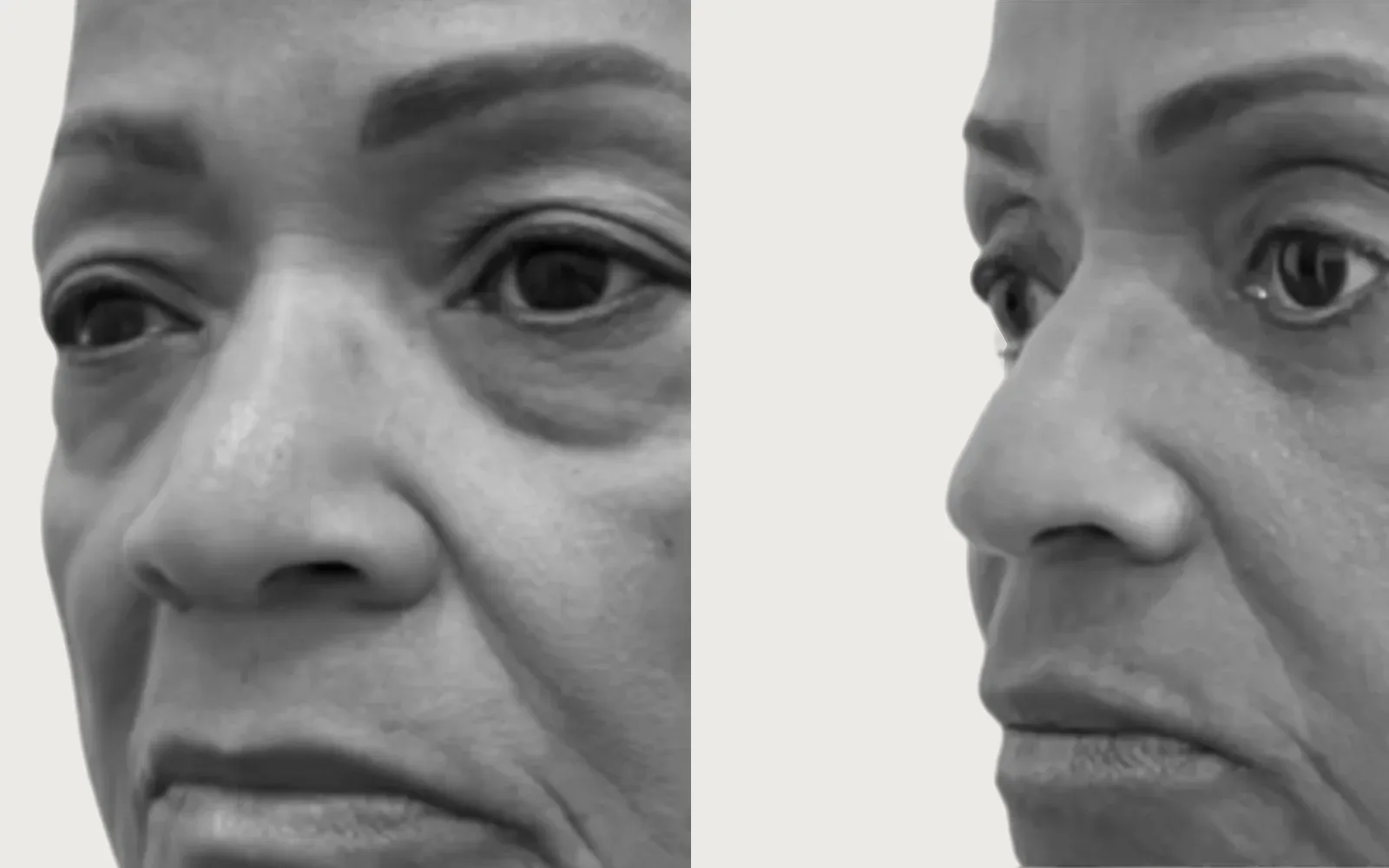 Eyelid / Brow Surgery before and after, patient 4, Holy City Plastic Surgery, Charleston SC