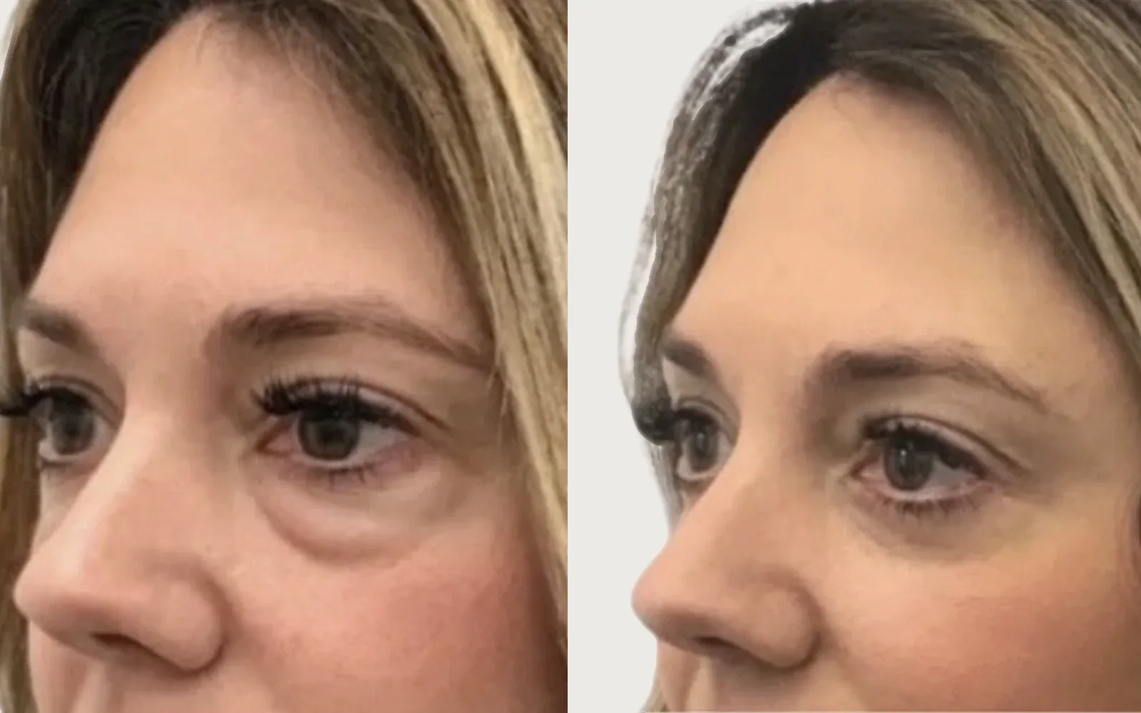 Eyelid / Brow Surgery before and after, patient 5, Holy City Plastic Surgery, Charleston SC
