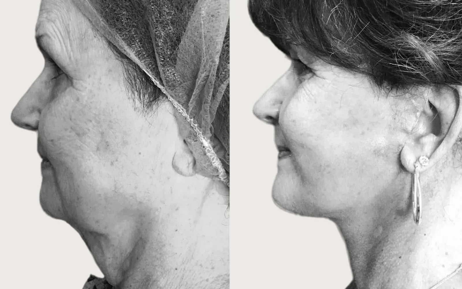 Facelift and Neck Lift before and after, patient 1, Holy City Plastic Surgery, Charleston SC