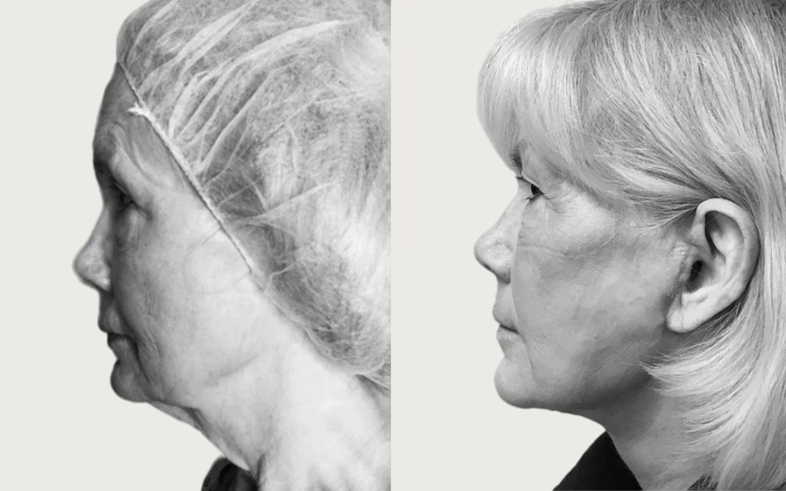 Facelift and Neck Lift before and after, patient 2, Holy City Plastic Surgery, Charleston SC