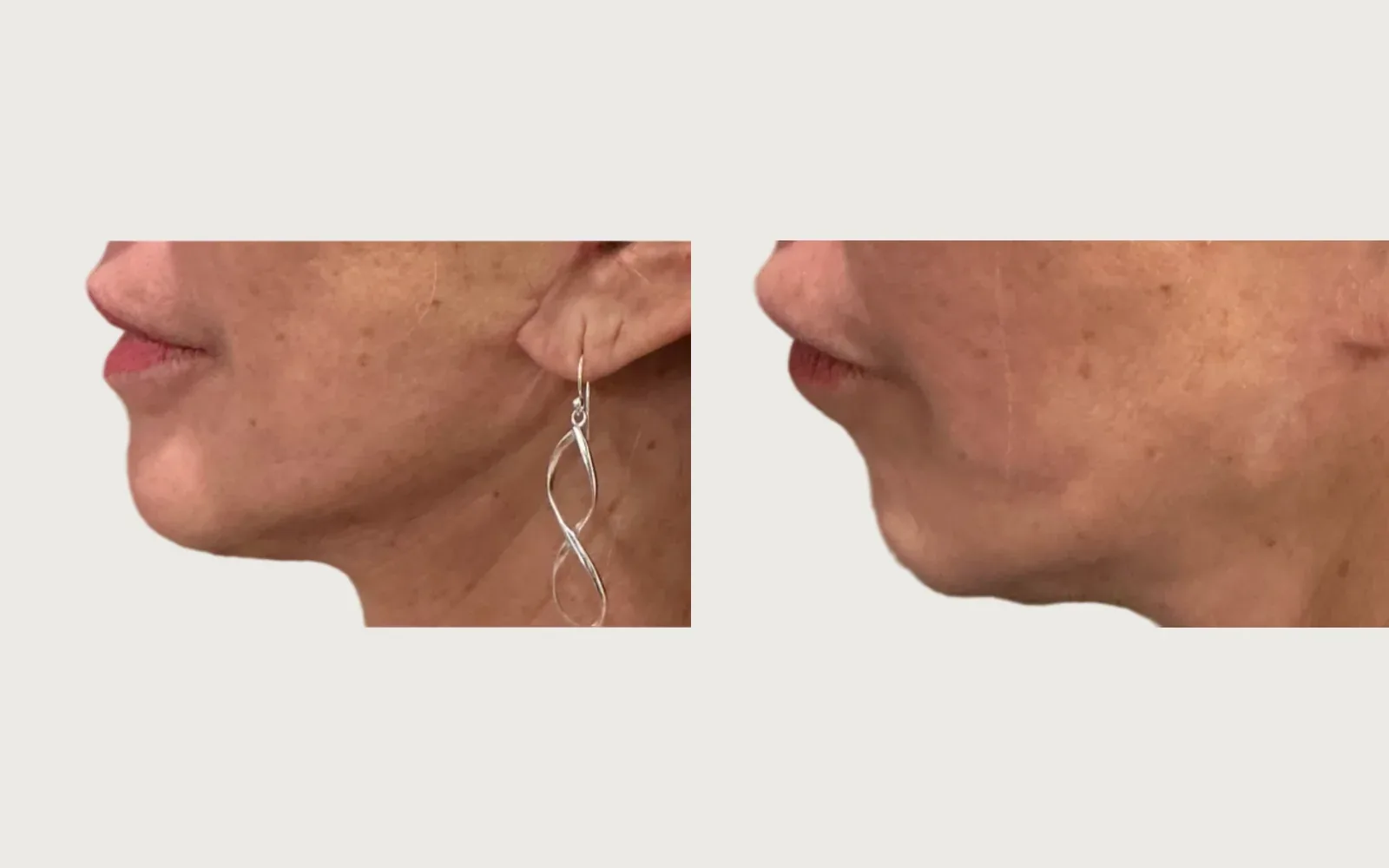 Facelift and Neck Lift before and after, patient 3, Holy City Plastic Surgery, Charleston SC