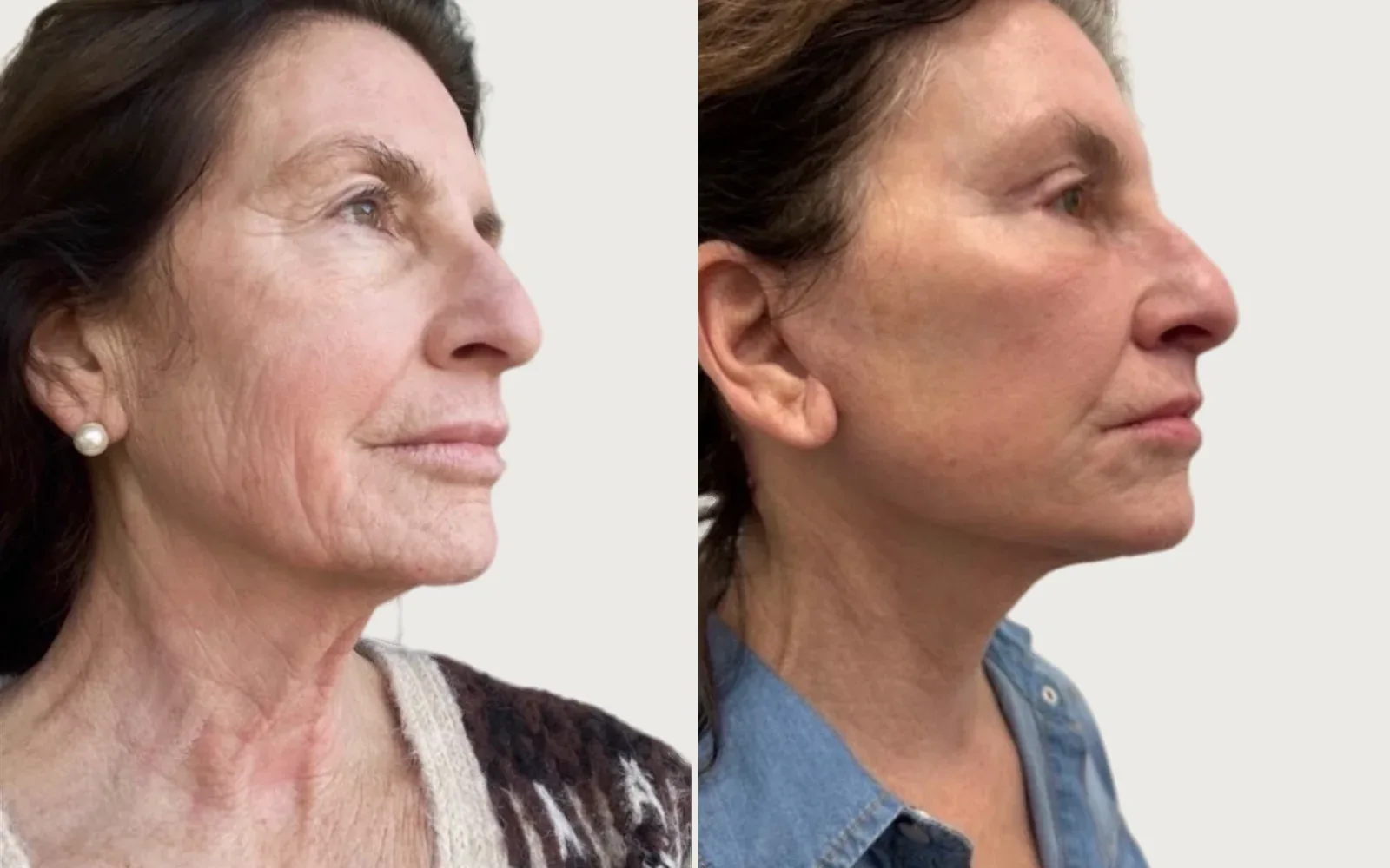 Facelift and Neck Lift before and after, patient 4, Holy City Plastic Surgery, Charleston SC