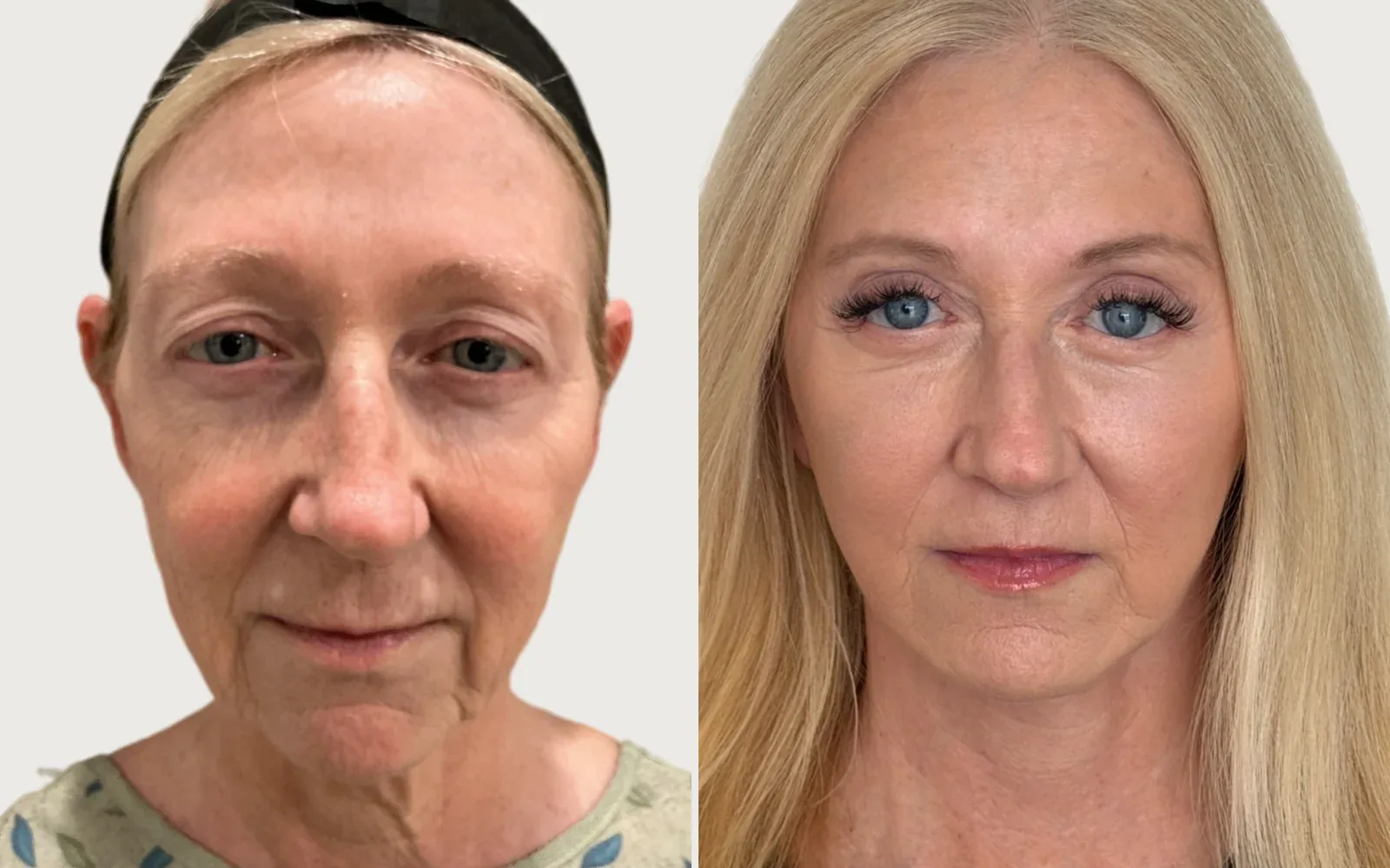 Facelift and Neck Lift before and after, patient 5, Holy City Plastic Surgery, Charleston SC