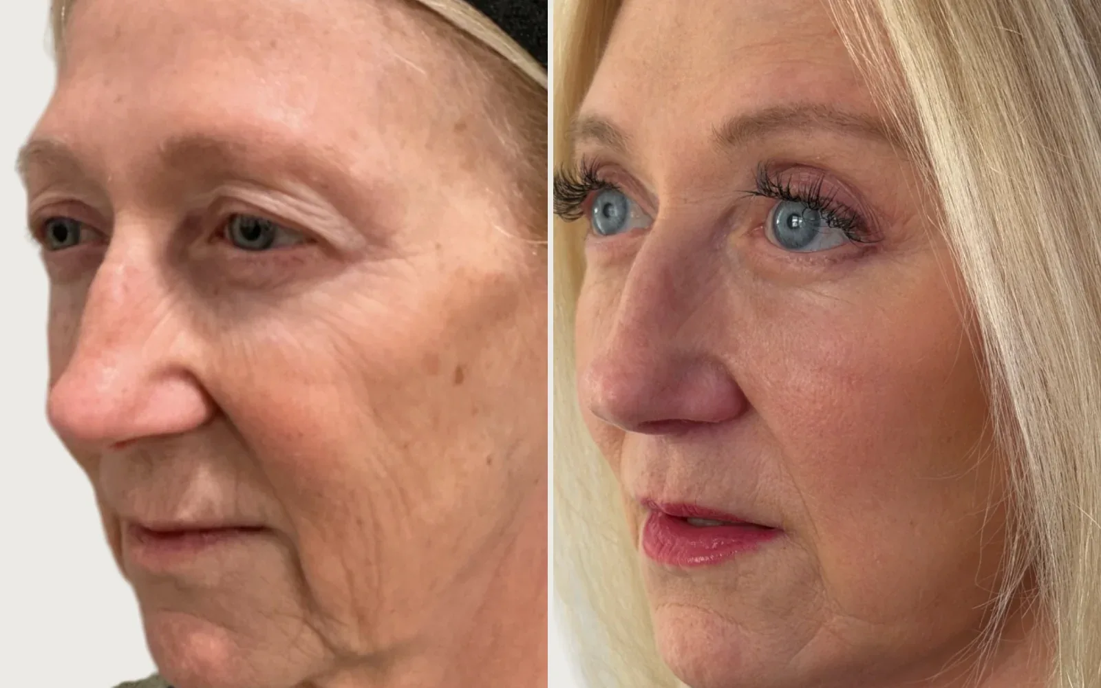 Facelift and Neck Lift before and after, patient 5, Holy City Plastic Surgery, Charleston SC