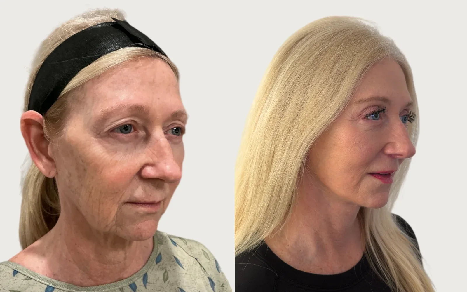 Facelift and Neck Lift before and after, patient 5, Holy City Plastic Surgery, Charleston SC