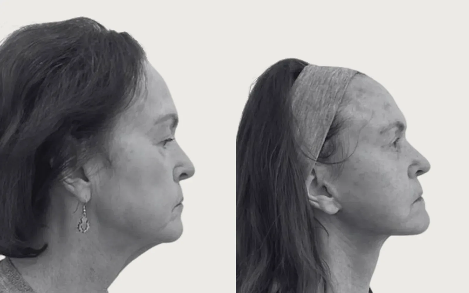 Facelift and Neck Lift before and after, patient 6, Holy City Plastic Surgery, Charleston SC
