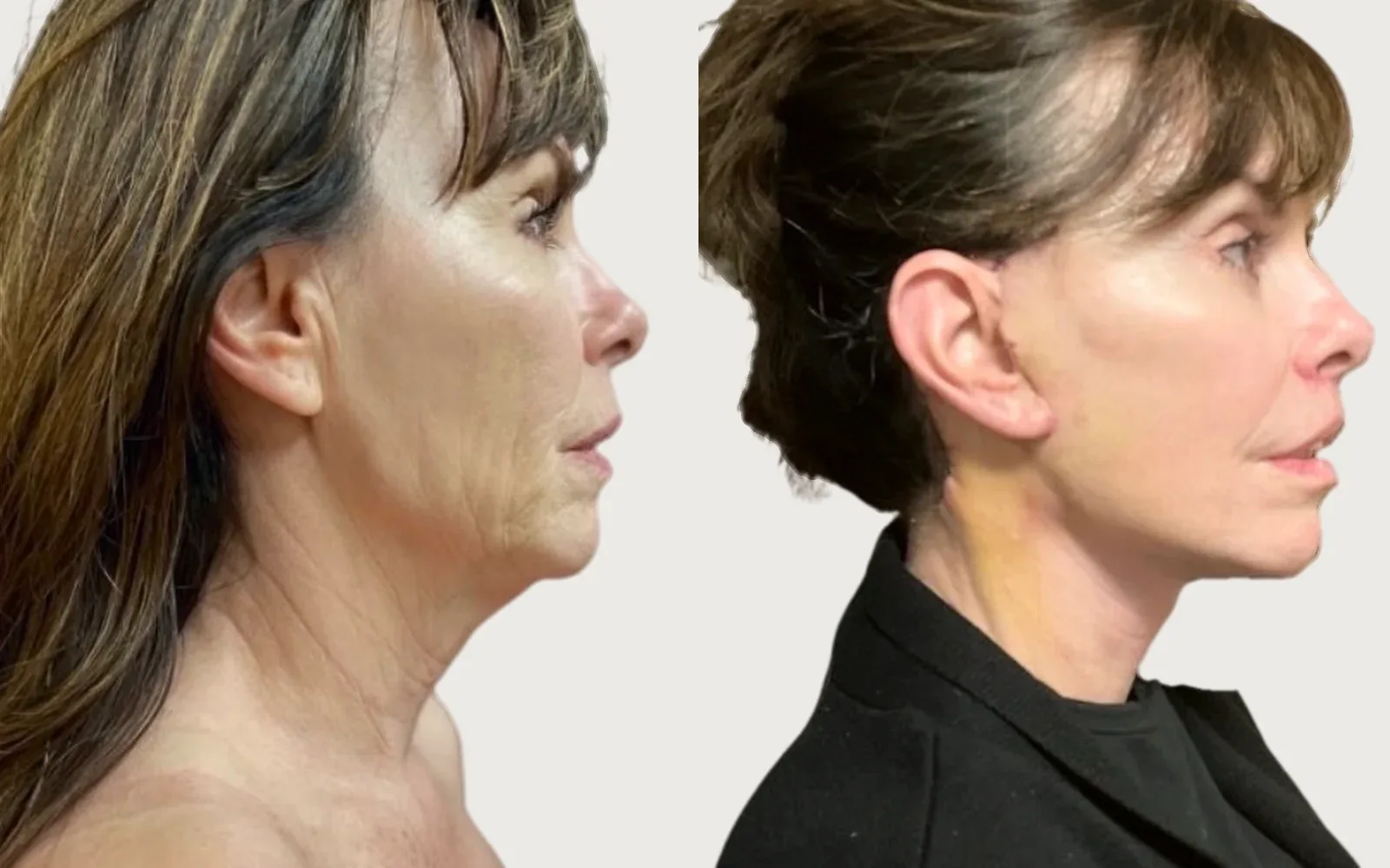 Facelift and Neck Lift before and after, patient 7, Holy City Plastic Surgery, Charleston SC